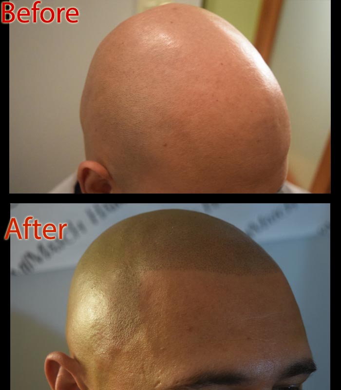 How Does SMP Look in the Sun? – DermMicro Scalp Products