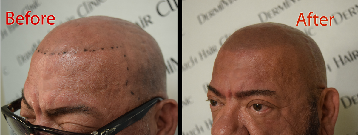 Why do Hair Stop Growing? – DermMicro Scalp Products