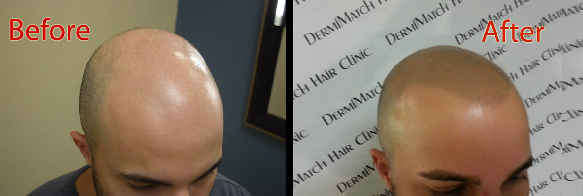 How To Stop Scalp Shine After Scalp Micropigmentation
