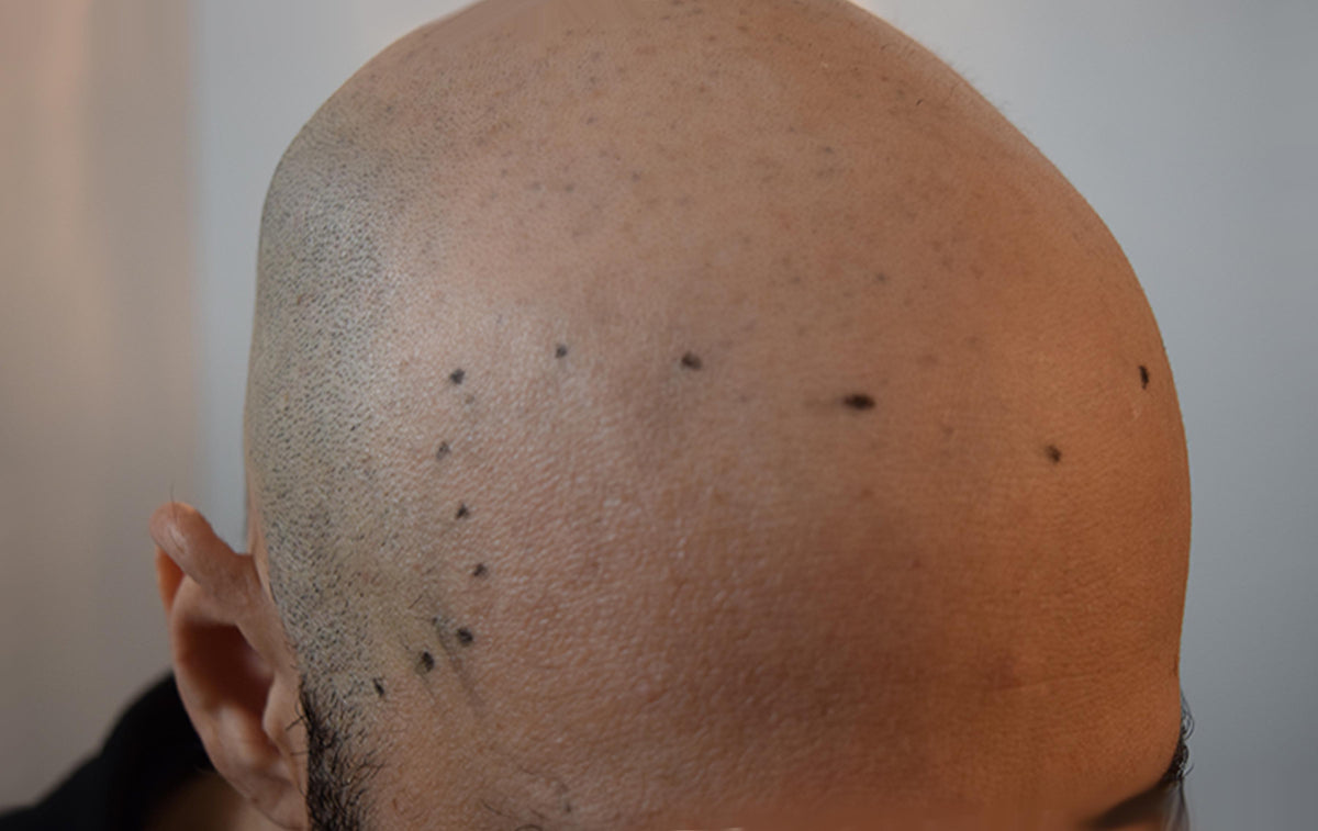 Do Hats Cause Baldness? DermMicro Scalp Products