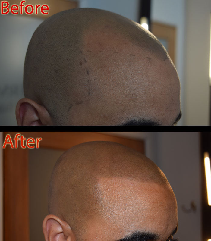 Why is My Head Red After SMP? DermMicro Scalp Products