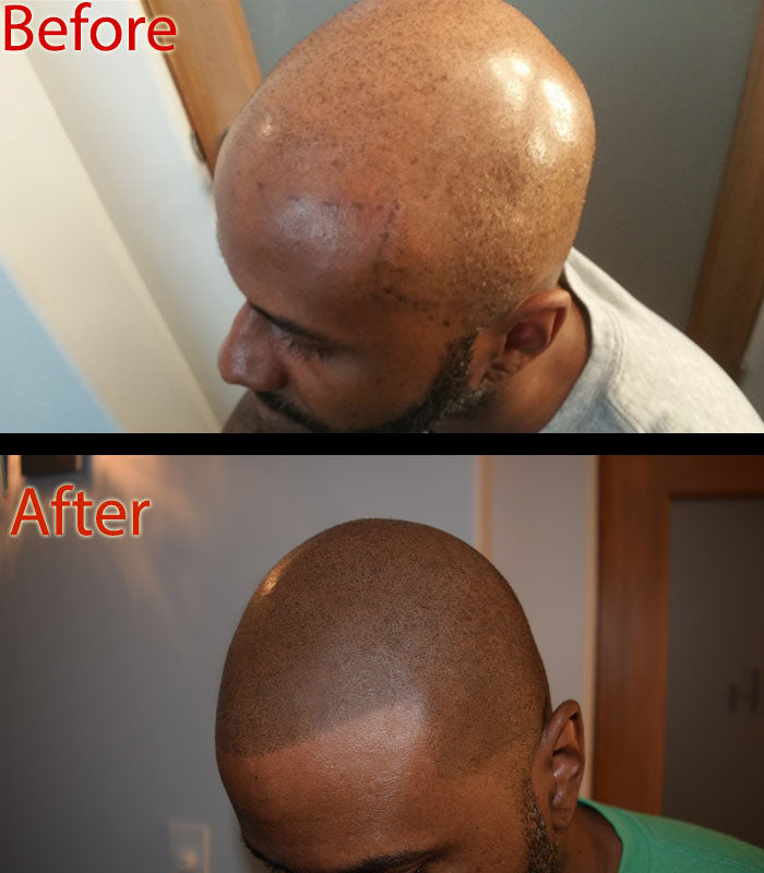 Zero Shine 2.0 by DermMicro - for matte effect after scalp  micropigmentation SMP