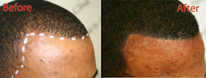 The Art of Scalp Care After SMP