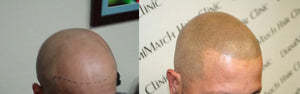 Scalp Micropigmentation: A Solution for a Shiny Scalp