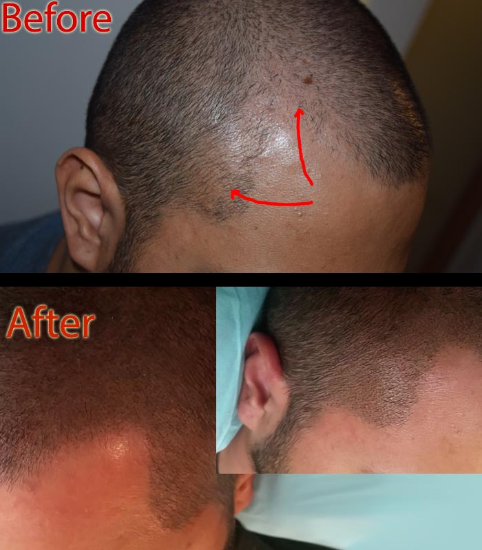 Is Micropigmentation of Scalp Safe?