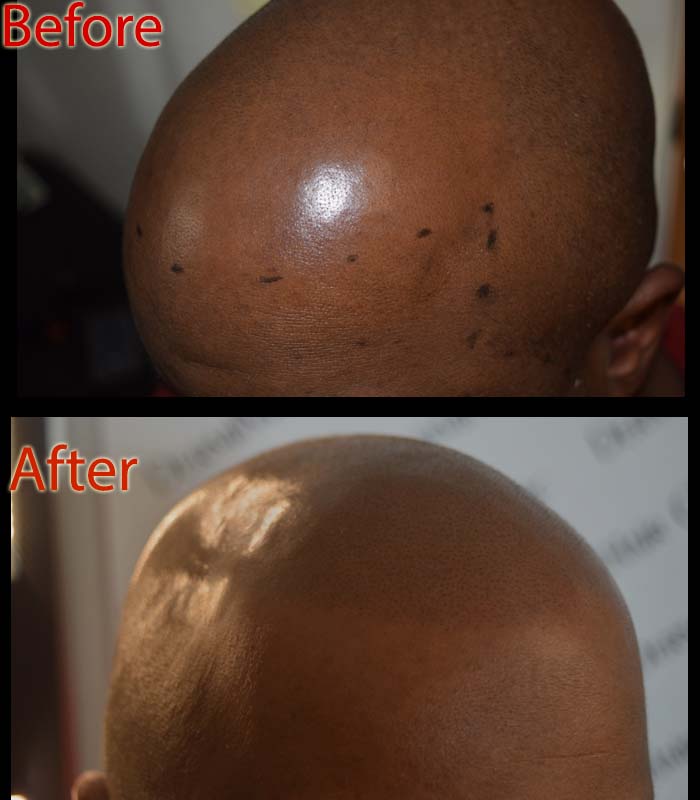 What Tools are Used for Scalp Micropigmentation?