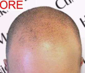 SMP Needle: Can I Use Tattoo Needle for Scalp Micropigmentation?