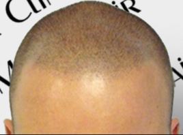 Caring for Your Bald Head and Managing Scalp Shine