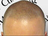 Redness After Scalp Micropigmentation: Is it Temporary?