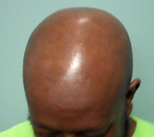 The Impact of Scalp Shine on SMP Realism