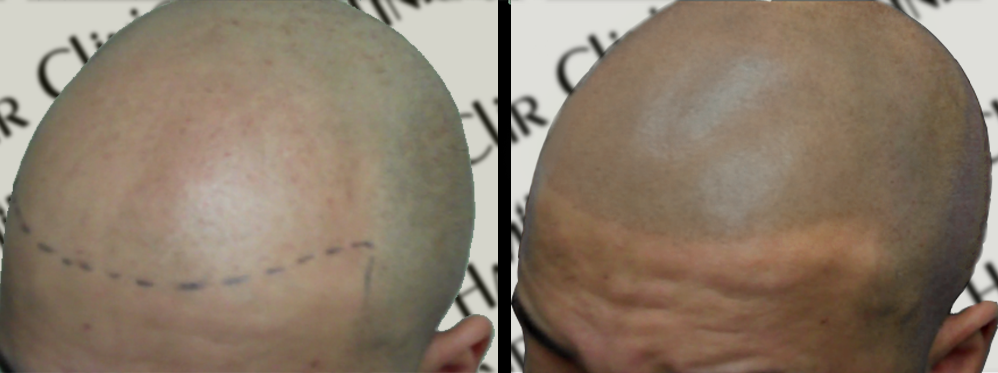 What is SMP for crown bald spot?