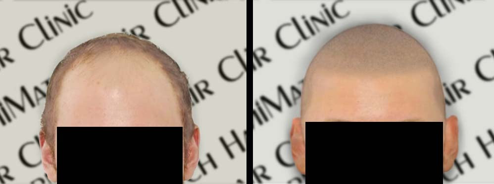Unveiling the Art & Science of Scalp Micropigmentation: A Comprehensive Training Guide