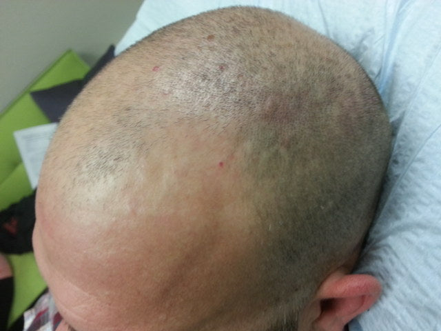 How Long Does It Take To Learn Scalp Micropigmentation?