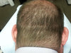 Does Micropigmentation Work on Scars?
