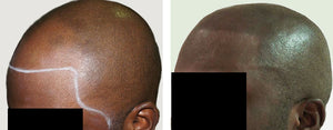 Braving the Needle: What to Expect from Scalp Micropigmentation Pain