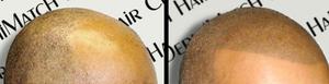 How To Prevent Oily Scalp Throughout the Day?