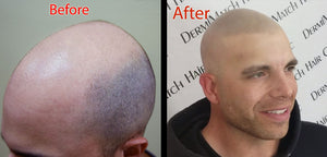 How Painful Is Scalp Micropigmentation?