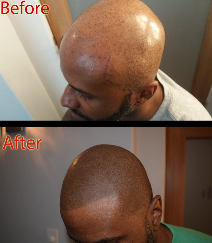 Why Scalp Shine Ruins the Look of Your SMP?