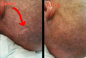 How To Conceal Hair Transplant Scars?