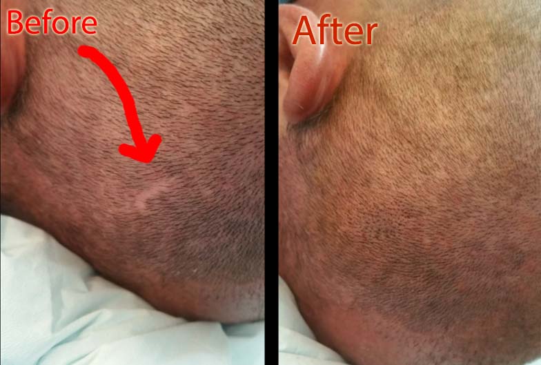 Does SMP Cover Head Scars – DermMicro Scalp Products
