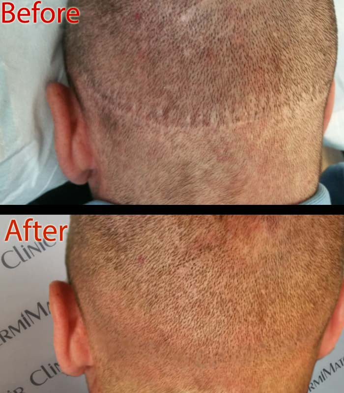 Types of Hair Transplant Scars Scalp Micropigmentation Can Fix