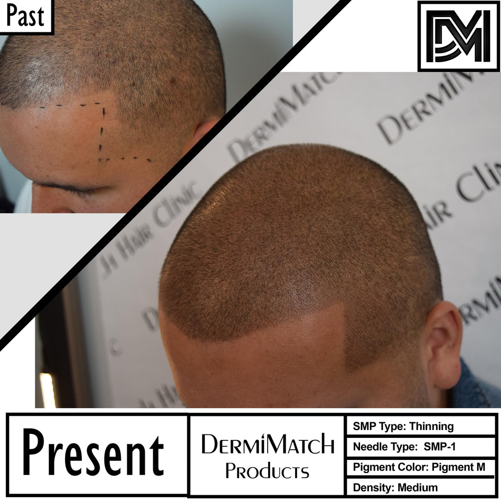 When Does Redness Go Away After A Scalp Micropigmentation Session?