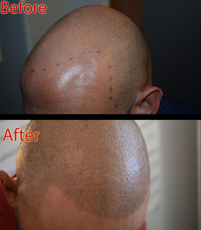 SMP Aftercare: How to Fix Your Shiny Head Problem