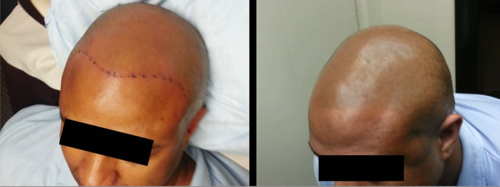 Shiny Scalp After SMP? The Solution is Here