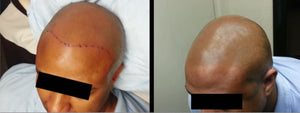 Shiny Scalp After SMP? The Solution is Here