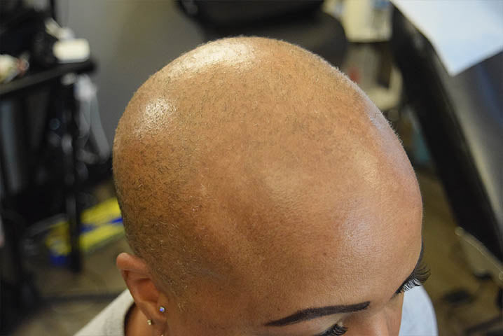 Does Shiny Scalp Mean Permanent Hair Loss?