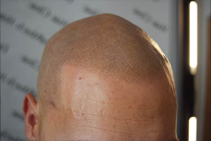 What Causes A Shiny Scalp?
