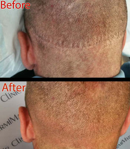 Can You Hide a Hair Transplant Scar?