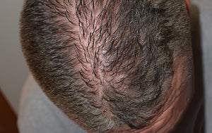 Signs of Damaged Hair Follicles