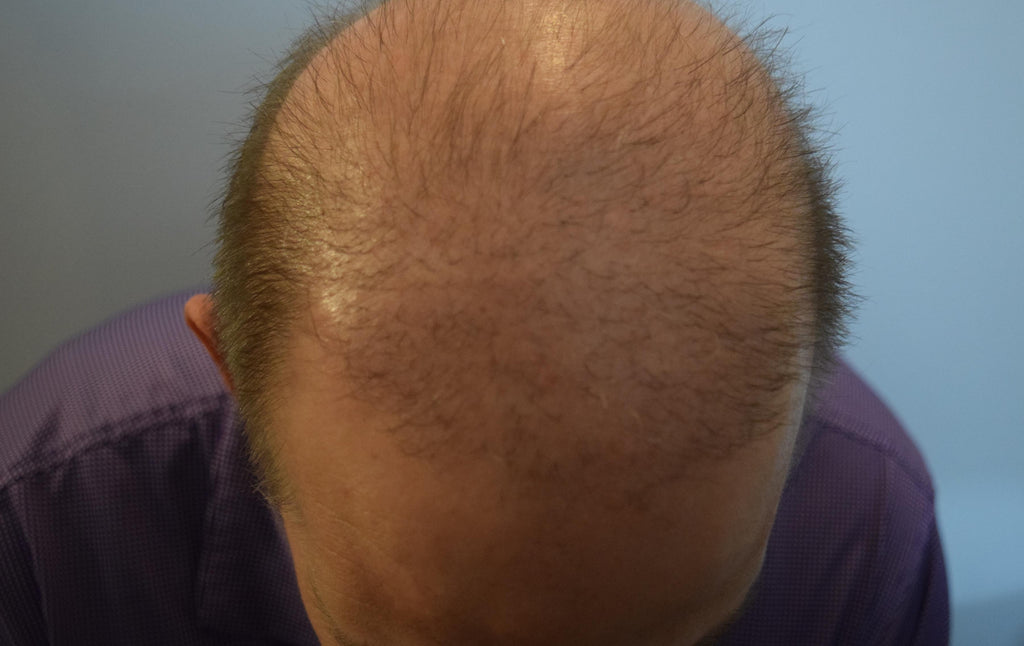 Does SMP Damage Hair Follicles?