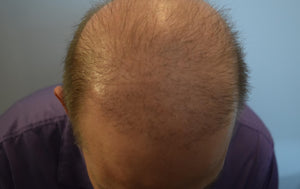 How To Know If You Are Going Bald?