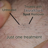 Spot Remover - By DermMicro